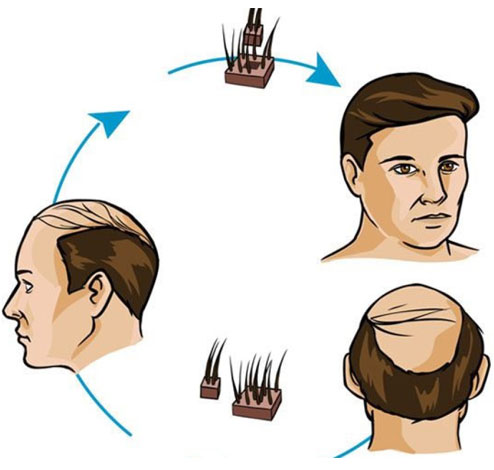 Non-Surgical Hair Replacement in Dubai, Kerala, Banagalore, Qatar