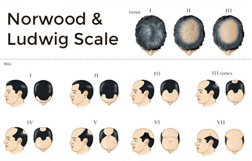 Surgical hair replacement in calicut